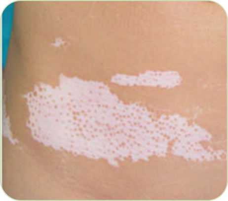 Perifollicular